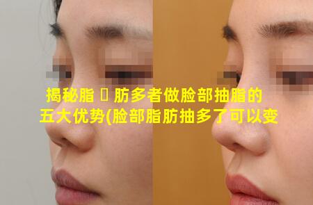 揭秘脂 ☘ 肪多者做脸部抽脂的五大优势(脸部脂肪抽多了可以变回去吗)